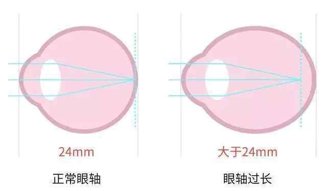 600度近视 600度以上的高度近视，比起普通近视，要多注意这些！