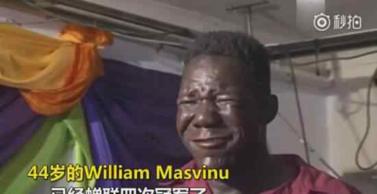 世界最丑的男人 世界最丑男人William Masvinu资料照片文章配图