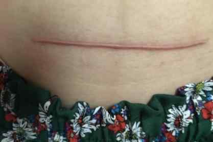 剖腹产15天伤口图片 秒懂剖腹产：剖腹产15天伤口图片 剖腹产恢复好的图片