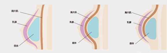 乳房假体植入 假体植入不同层次的对比