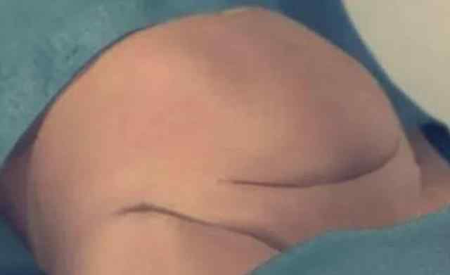 剖腹产全过程 剖腹产简单？快别说风凉话了，来看看真实的剖腹产全过程