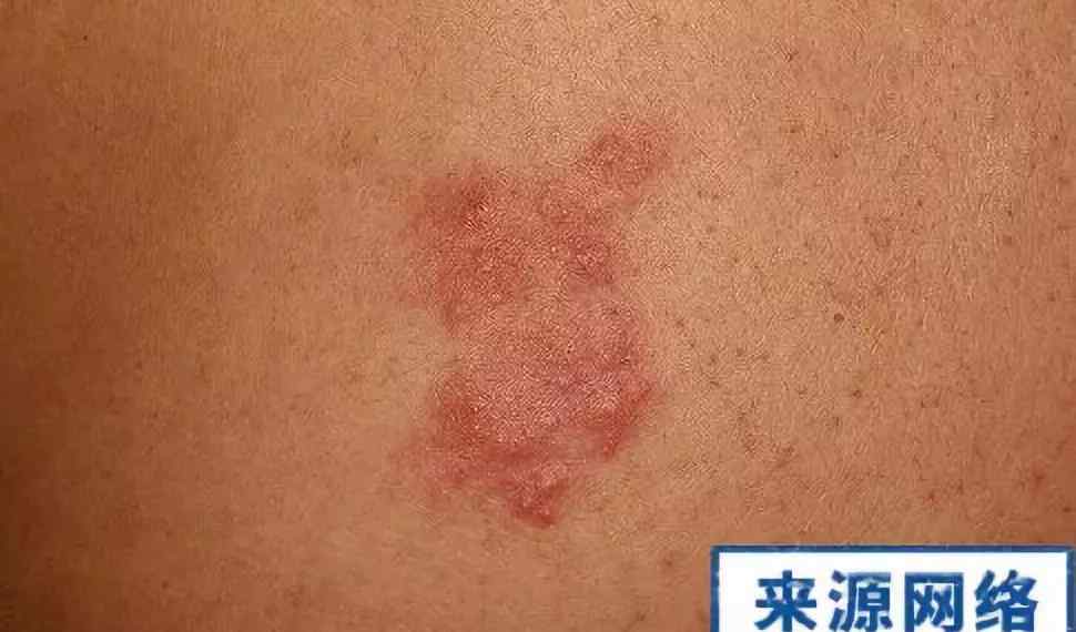 牛皮藓的症状 湿疹还是牛皮藓？傻傻分不清楚？
