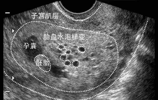 有胎心了孕囊旁有积液 孕囊旁有积液怎么回事？孕囊积液多大必须流产？文章配图