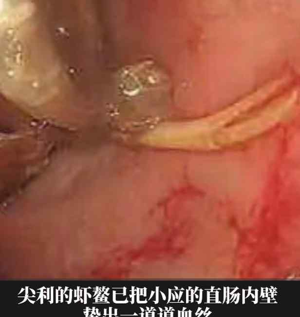 离奇！医生从男孩屁股钓出活龙虾 原因让人哭笑不得