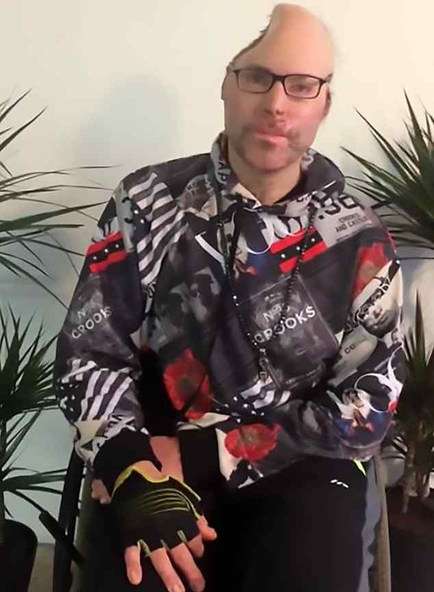在家自制剧毒 男子在家自制毒品发生爆炸，半个头骨被切除
