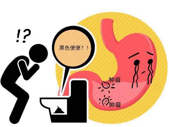 腹胀腹痛 长期腹痛腹胀就是胃癌？医生直言：伴随4种异常，或是胃癌在发声