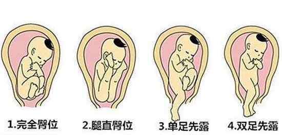臀位能顺产吗 臀位，一般情况下还能顺产吗？
