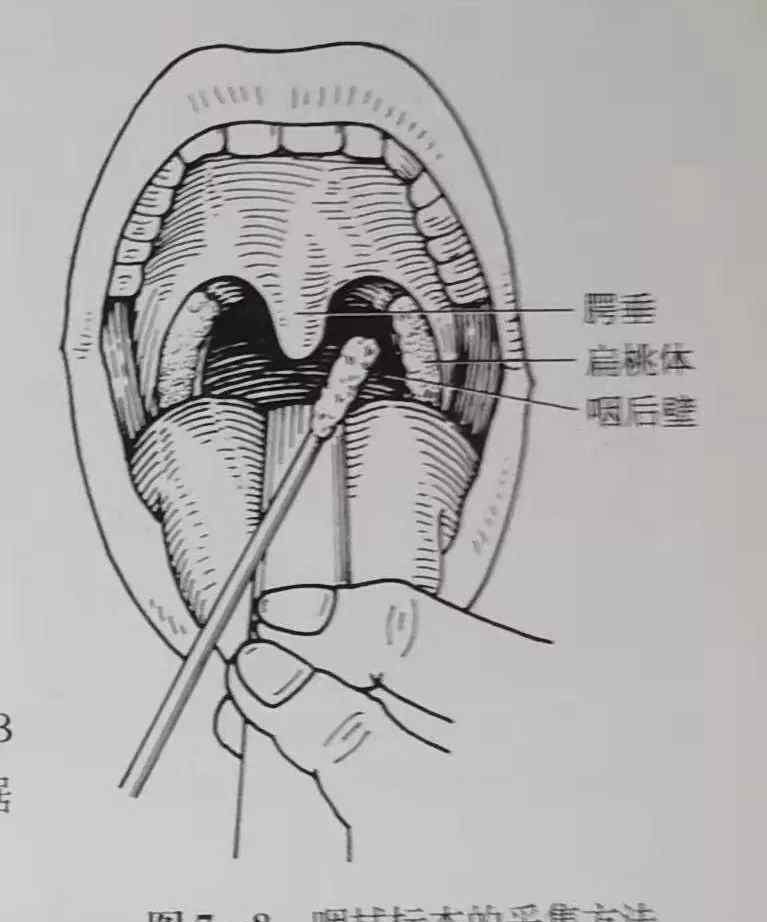 咽拭子一般检查什么病 咽拭子常做，可你真的做对了吗？