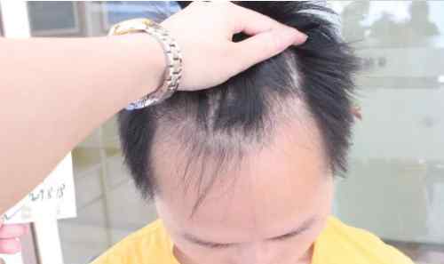 m型脱发长回来了 M型脱发，做回普通人很难吗？脱发的人才会懂