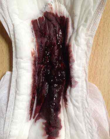 月经正常经血图片 用月经血涂上照片让人倒霉真假，如果沾了月经血倒霉怎么办？