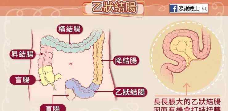 乙状结肠 肠子也会打结？来看看乙状结肠扭转！