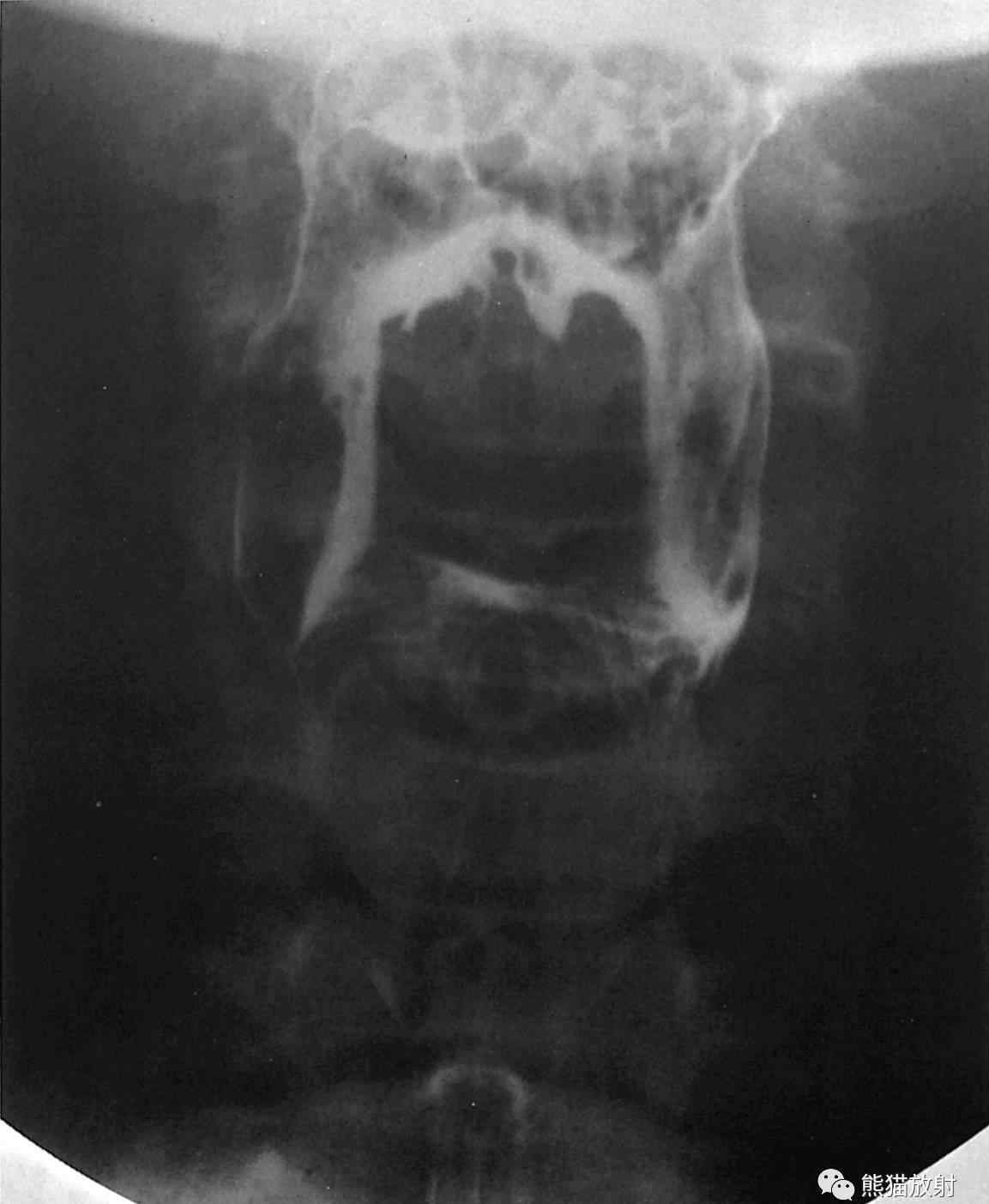 esophagus 【X线解剖】消化道造影（11组图：咽部至直肠）+彩色解剖图文章配图