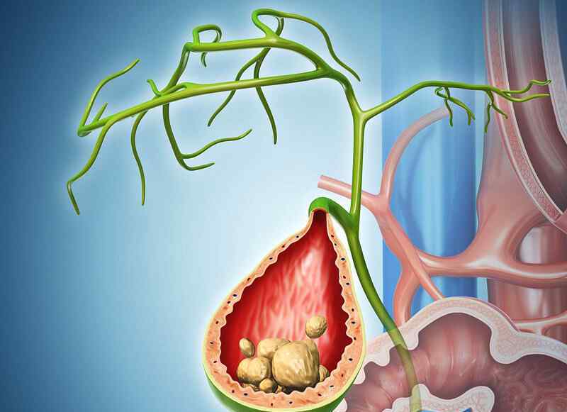 胆结石的方法 有效治疗胆结石的方法有哪些？跟随医生一起看看！