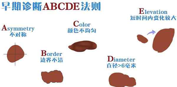 恶性黑色素瘤图片 以为黑痣却是恶性黑色素瘤，这种疾病常常被人忽视耽误治疗