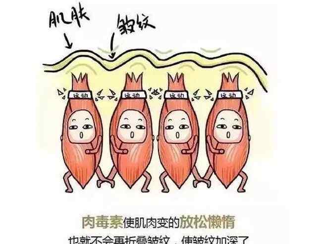 面部皱纹 面部皱纹都有哪些种类？该如何除皱呢？