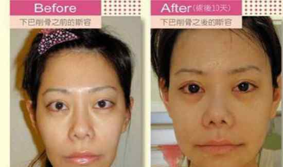 整容的后遗症 整容后遗症有多可怕？整容老了以后真可怕图