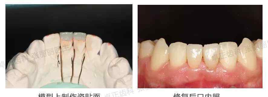 牙齿缺损 牙齿缺损了，可以选择哪些修复方式？