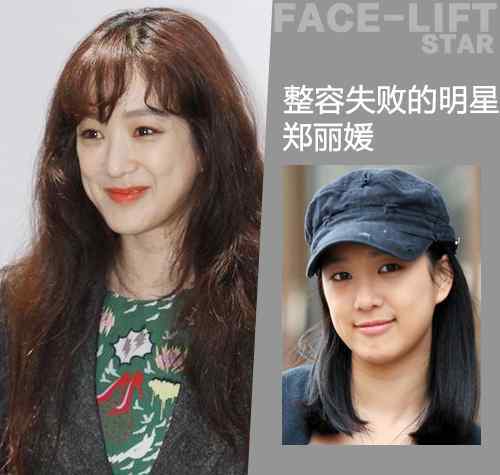 整容的后遗症 整容后遗症有多可怕？整容老了以后真可怕图