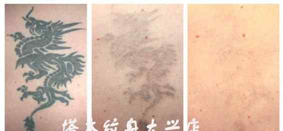 洗纹身 北京洗纹身是去医院好还是纹身店好一些