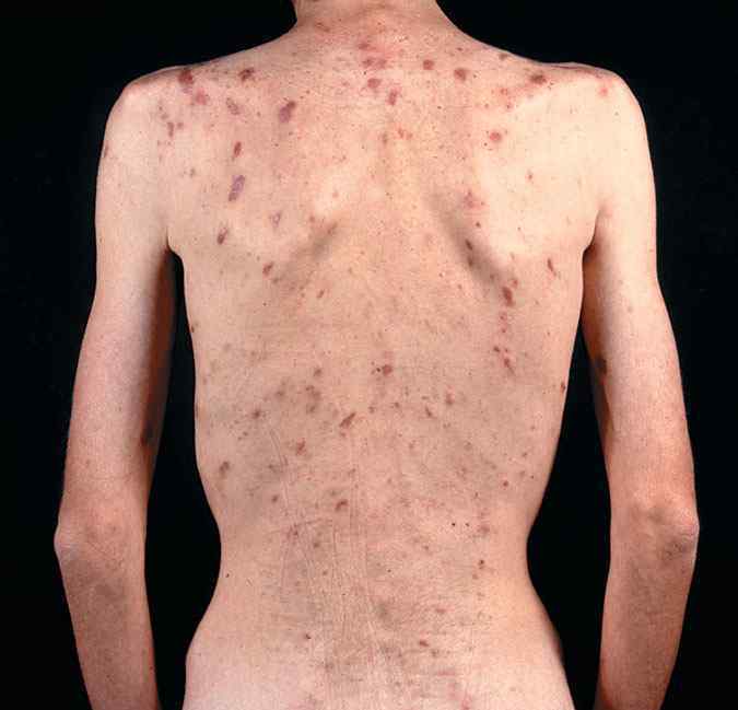 艾滋病人图片 越南女为何多患艾滋病？女人患艾滋病症状图片
