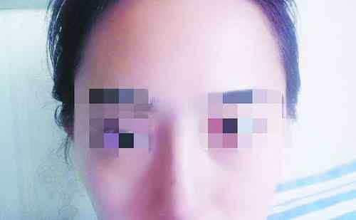 厦门吸脂接洽莫琳娜 厦门女子隆鼻两月后鼻腔仍发炎 找整形医院赔偿却被“拉黑”