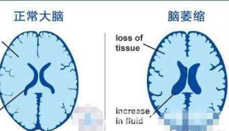 小脑萎缩的症状 什么是小脑萎缩？小脑萎缩的症状有哪些？