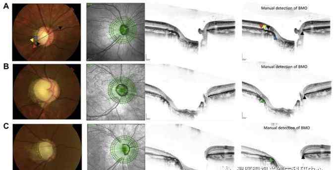 bruch OCT难以精准测量 青光眼合并高度近视病人的Bruch膜开口距离？