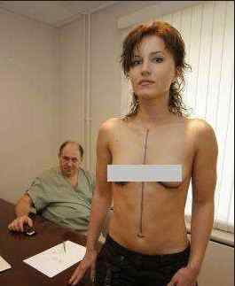 假体隆胸手术全过程视频 震撼实拍美女隆胸过程，实拍美女隆胸手术视频