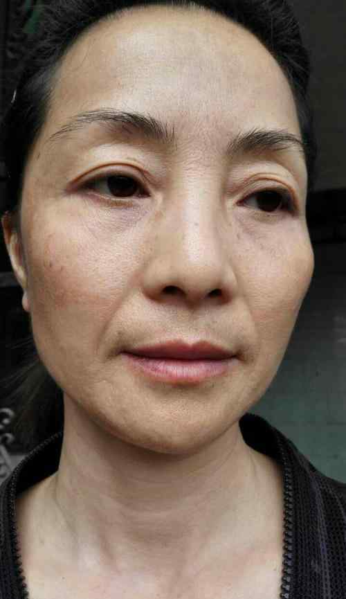 黄褐斑遗传吗 医生：苹果加1物，扫除满脸黑色素，黄褐斑也慢慢消失了