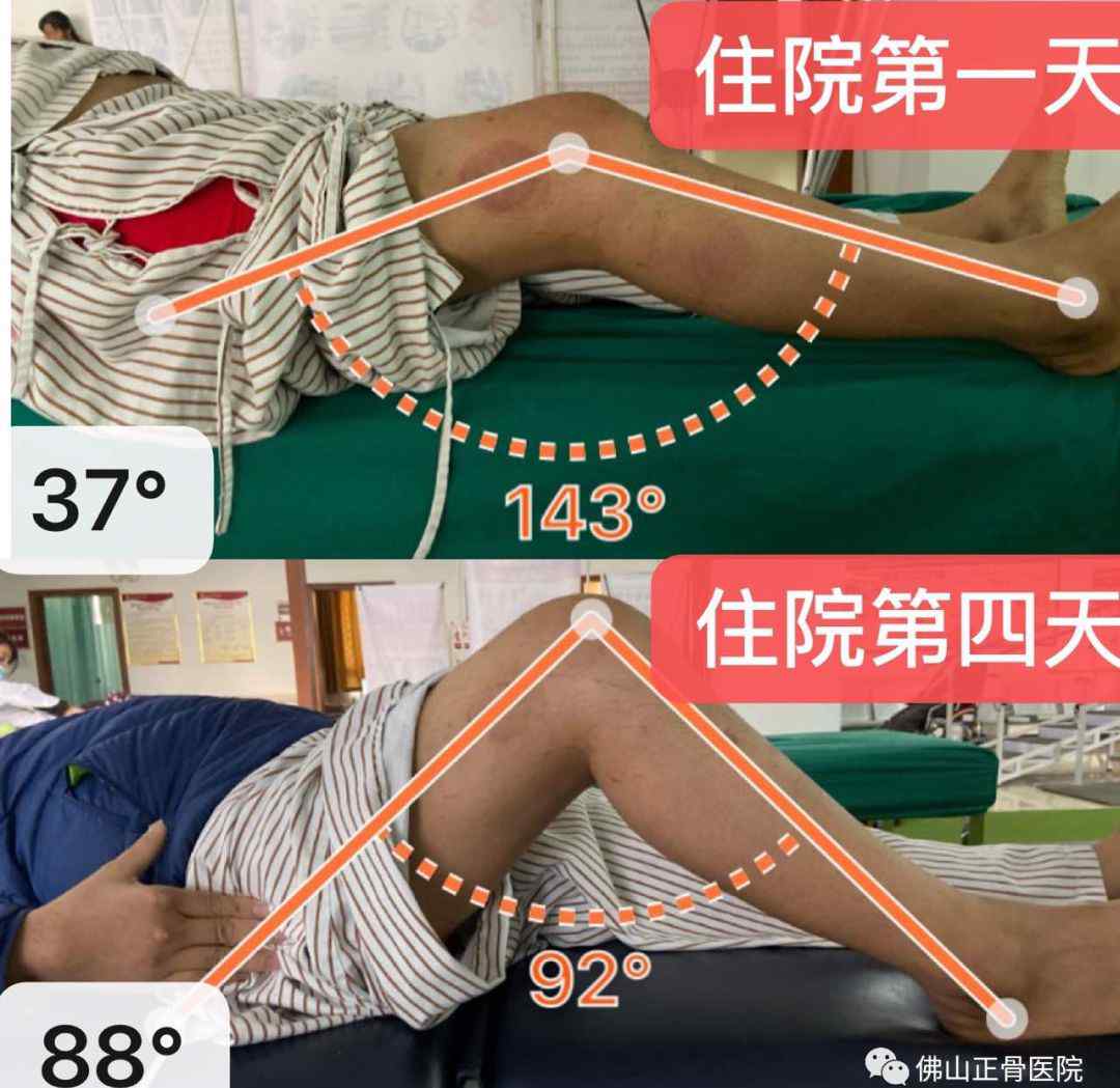 骨折后遗症 骨折后还会有后遗症？赶紧看看怎么一回事！
