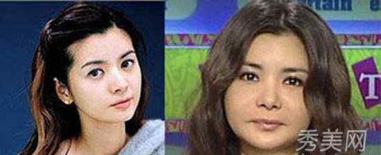 人变人鱼手术 美女整容后变毁容图，真实整容手术毁容照片