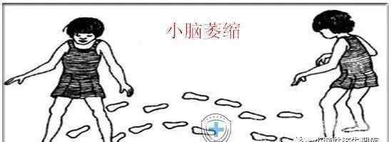 脑萎缩的症状 什么是小脑萎缩？小脑萎缩的症状有哪些？