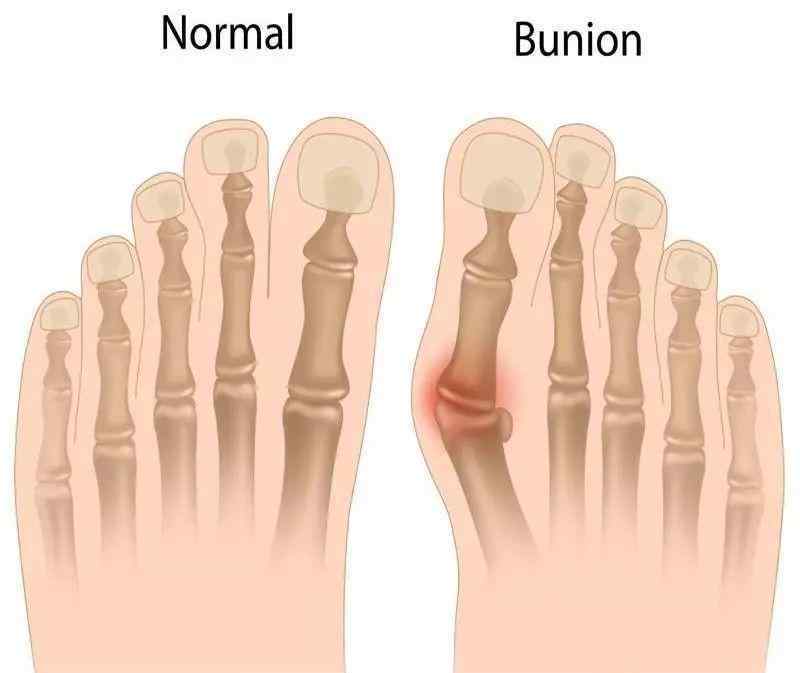 脚大拇指关节外翻 女性常见脚部畸形：拇指外翻！