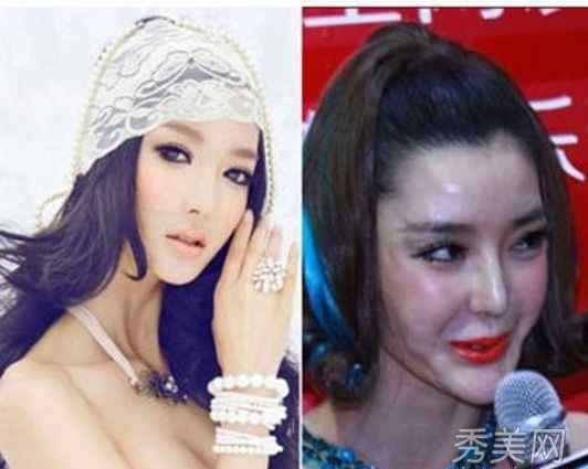 毁容 美女整容后变毁容图，真实整容手术毁容照片