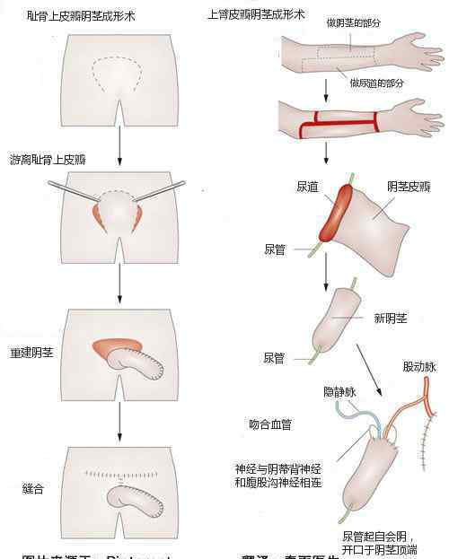 可以吗 女变男真的可以当男人吗，世界上女变男的变性人真实照片