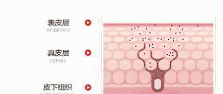 调q激光祛斑好吗 祛斑选择普通调Q激光还是皮秒激光？激光祛斑后反黑怎么办？