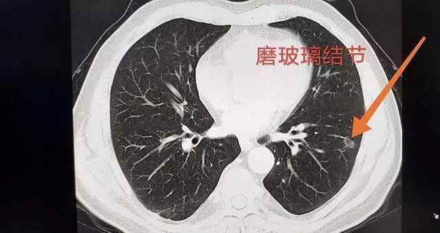 肺磨玻璃影 肺部磨玻璃样影到肺癌有多远？文章配图
