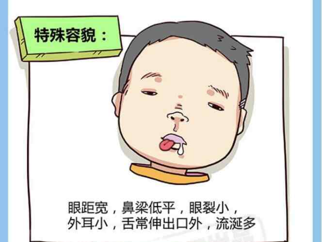 唐氏儿外貌图片 国际脸就是唐氏的弱智脸吗？唐氏国际脸判断图片是怎样的