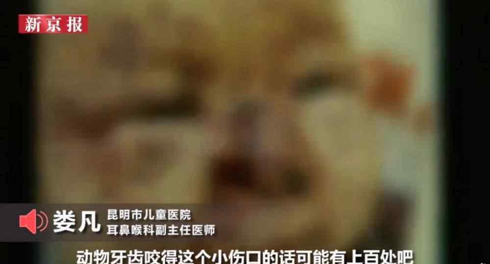 被老鼠咬了打什么疫苗 被老鼠咬伤后，要不要打狂犬疫苗？