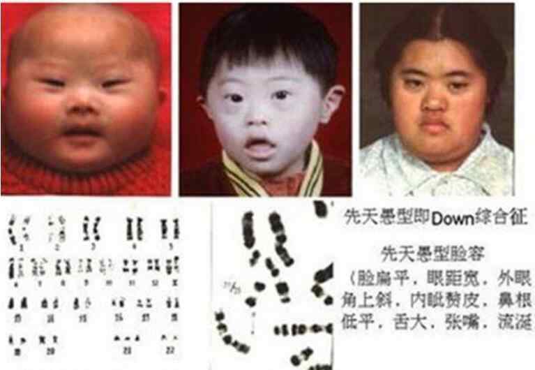 唐氏儿的眼睛图片 国际脸就是唐氏的弱智脸吗？唐氏国际脸判断图片是怎样的