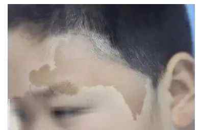 治疗咖啡斑 【胎记的那些事】咖啡斑的激光治疗