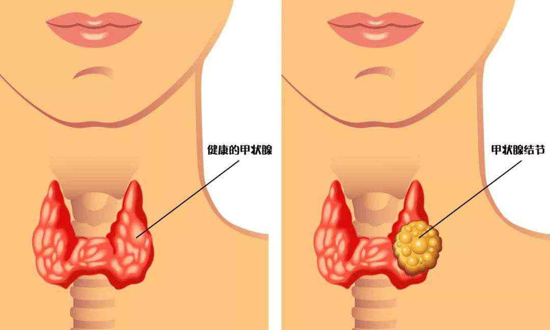 甲状腺囊腺瘤 甲状腺肿瘤1年内从1cm长到3cm！小心，3种食物会加速肿块生长