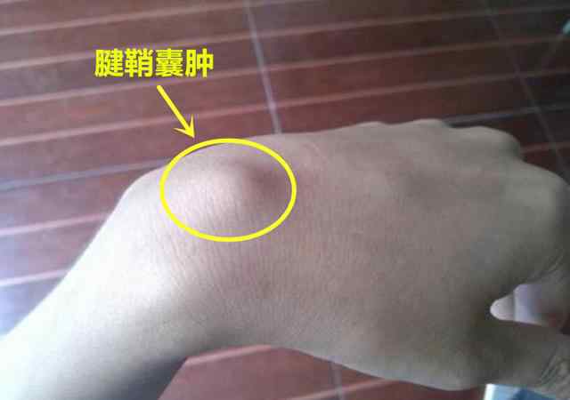 腱鞘囊肿会自己消失吗 一个小妙招，轻松解决腱鞘囊肿，您学会了吗？文章配图