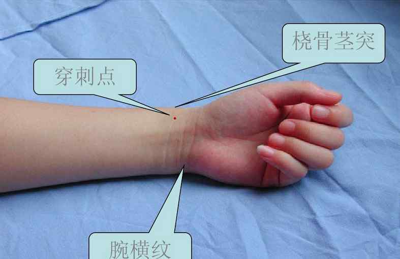 执业医师实践技能考试 执业医师实践技能考试复习资料：动静脉穿刺术文章配图