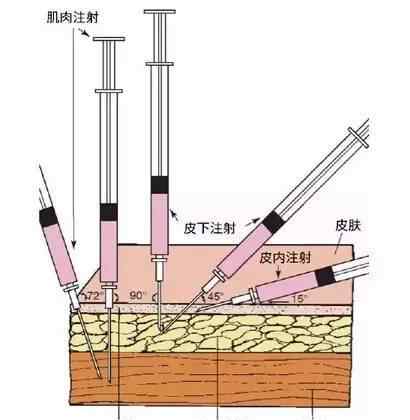 皮下针注射位置图 皮内注射、皮下注射、肌肉注射、静脉注射的区别！