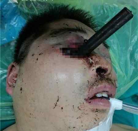 男子命悬一线！ 金属管插入男子眼部深入颅内
