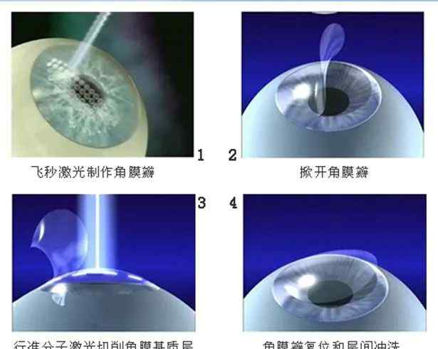 飞秒激光治疗近视手术 飞秒激光近视手术治疗新进展文章配图