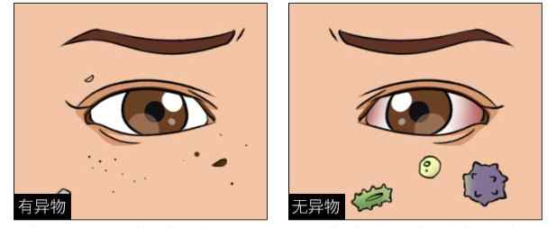 眼睛里有异物 眼睛有“异物感”是怎么回事？让你看完也成专家文章配图