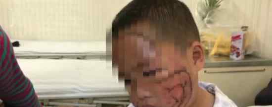 可怜！ 3岁男童脸部惨遭哈士奇撕咬缝合200多针文章配图