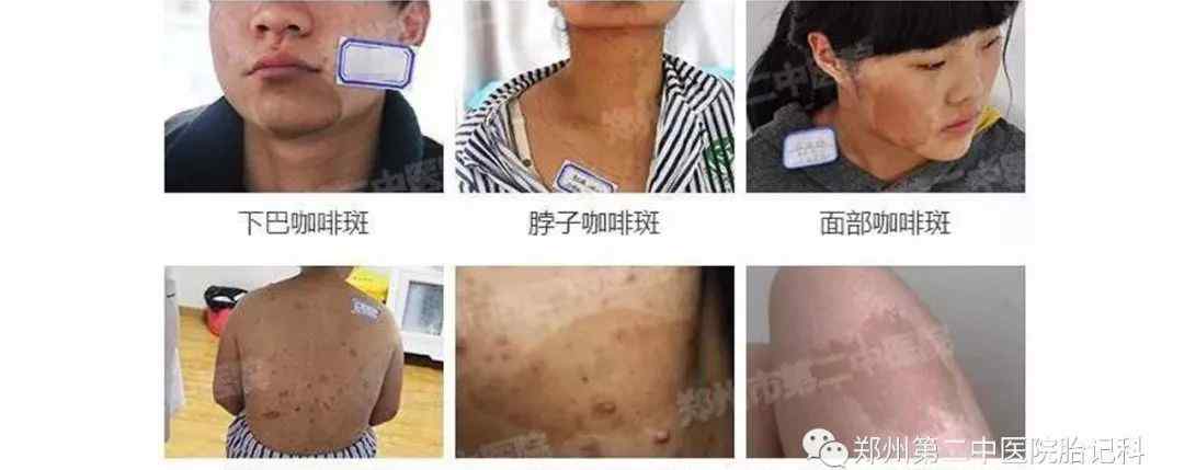 皮肤咖啡斑 答疑：为什么我会有咖啡斑?文章配图